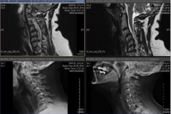 Cervical disc herniations — spondyloses