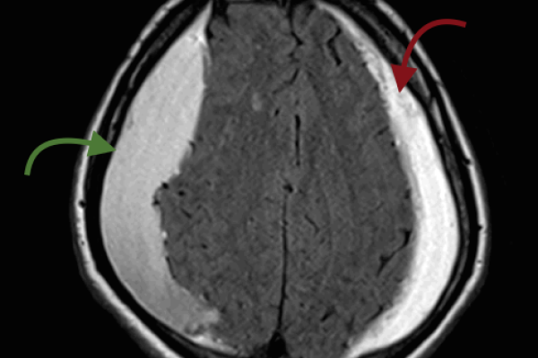 KRONIK SUBDURAL HEMATOM