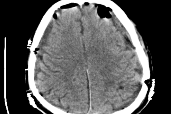 KRONIK SUBDURAL HEMATOM