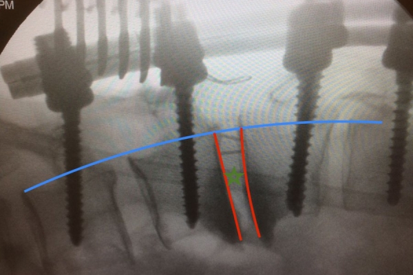 Deformity (Spinal Curvature—Kyphosis) Surgery (Kyphoscoliosis)