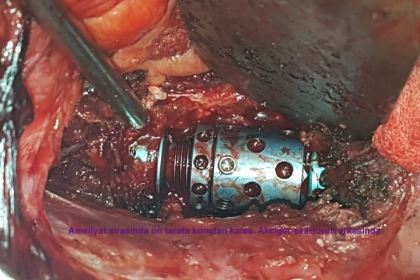 Torakotomi (göğüs kafesinden girilerek) omurga tümörü ameliyatı