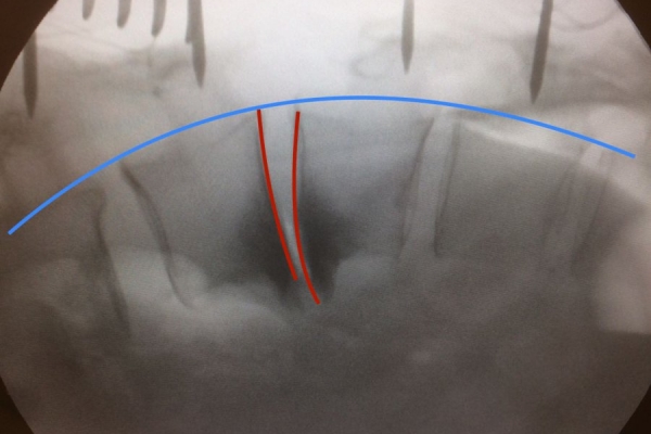 Deformity (Spinal Curvature—Kyphosis) Surgery (Kyphoscoliosis)